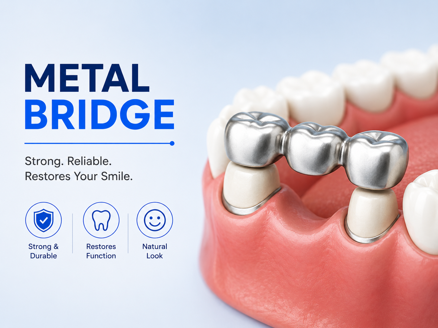Metal Dental Bridge: A Durable Solution for Replacing Missing Teeth