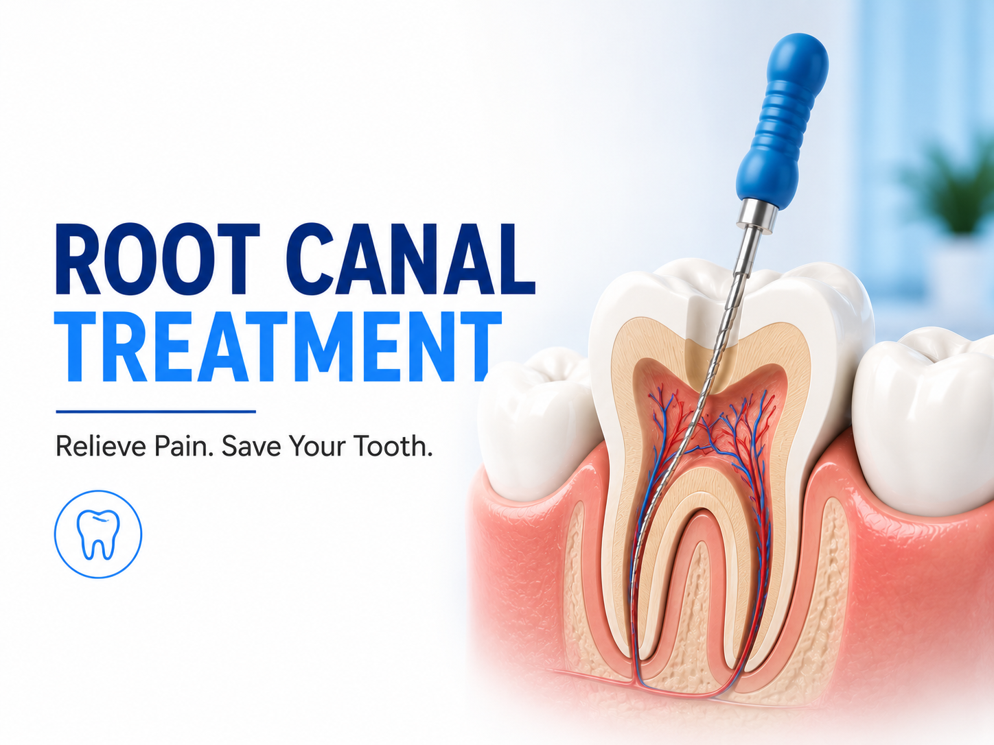 Root Canal Treatment